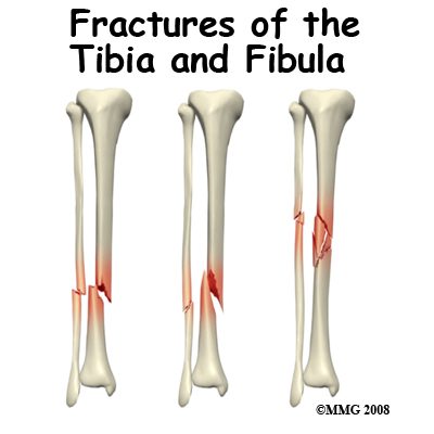 Tibia and fibula, shaft