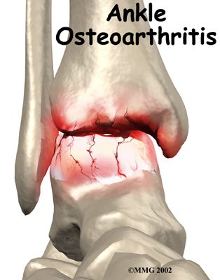 Psoriatic Arthritis