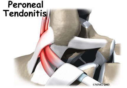 Psoriatic Arthritis