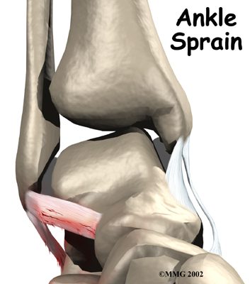 Psoriatic Arthritis