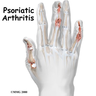 Psoriatic Arthritis in the Ankle: Symptoms, Causes, Treatments